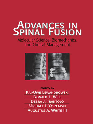cover image of Advances in Spinal Fusion